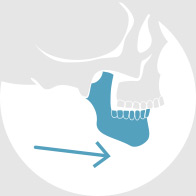 Neonatal Mandibular Distraction