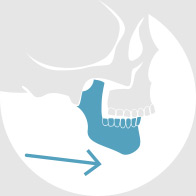 Mandibular Distraction