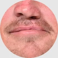 Close-up of nose and mouth with scar from cleft palate repair