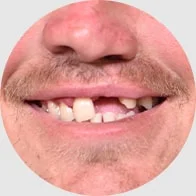 Mouth and nose, smiling with missing front tooth