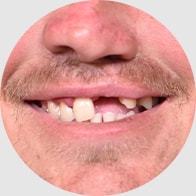 Mouth and nose, smiling with missing front tooth