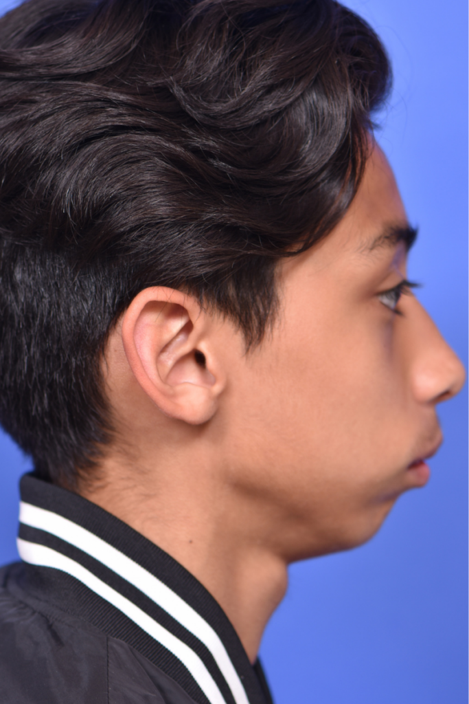 Before