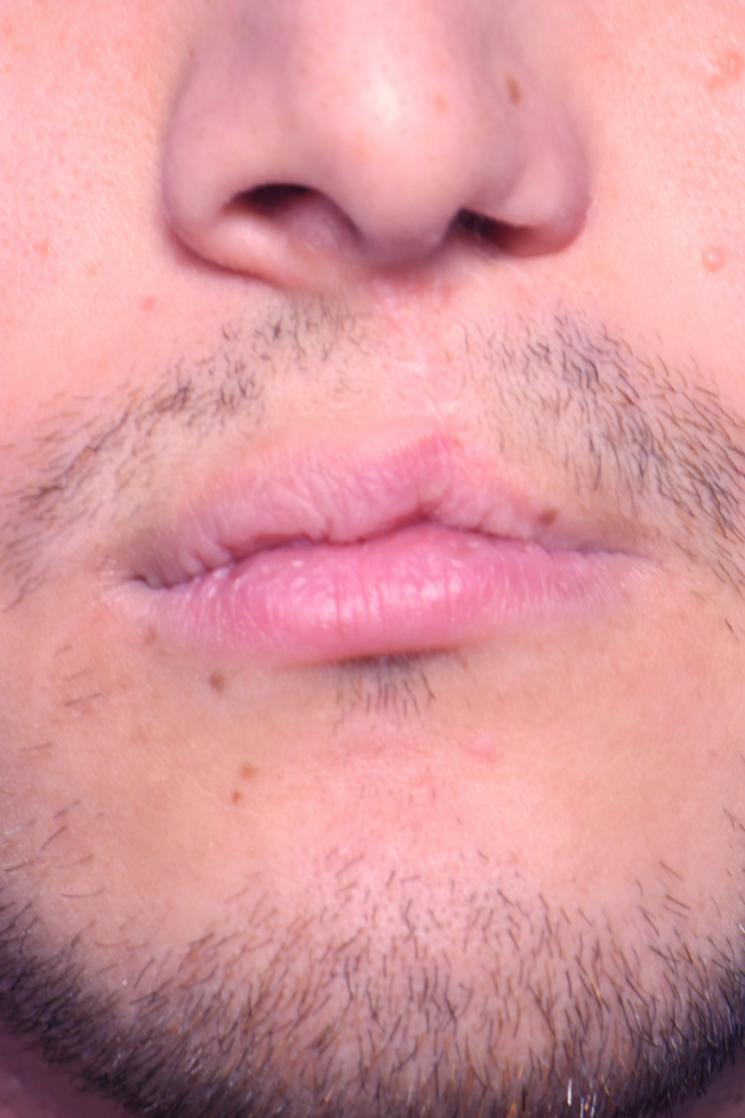 Before
