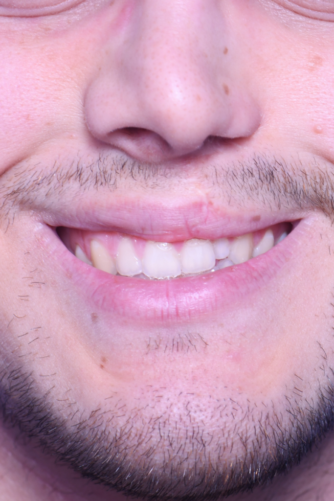Before